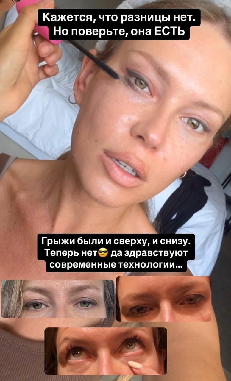 «Грыжи были сверху и снизу»: Рита Дакота радуется переменам на лице после пластики