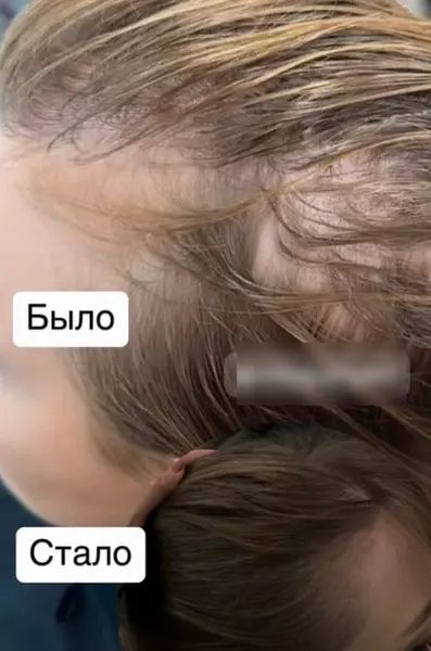 Молодая жена Диброва облысела из-за одного шага – жуткое фото Молодая жена Диброва облысела из-за одного шага – жуткое фото